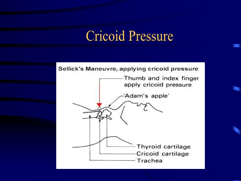 Cricoid Pressure